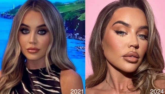 Samantha Kenny Love Island Before And After Surgery